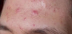 Multi Functional Blackhead Remover